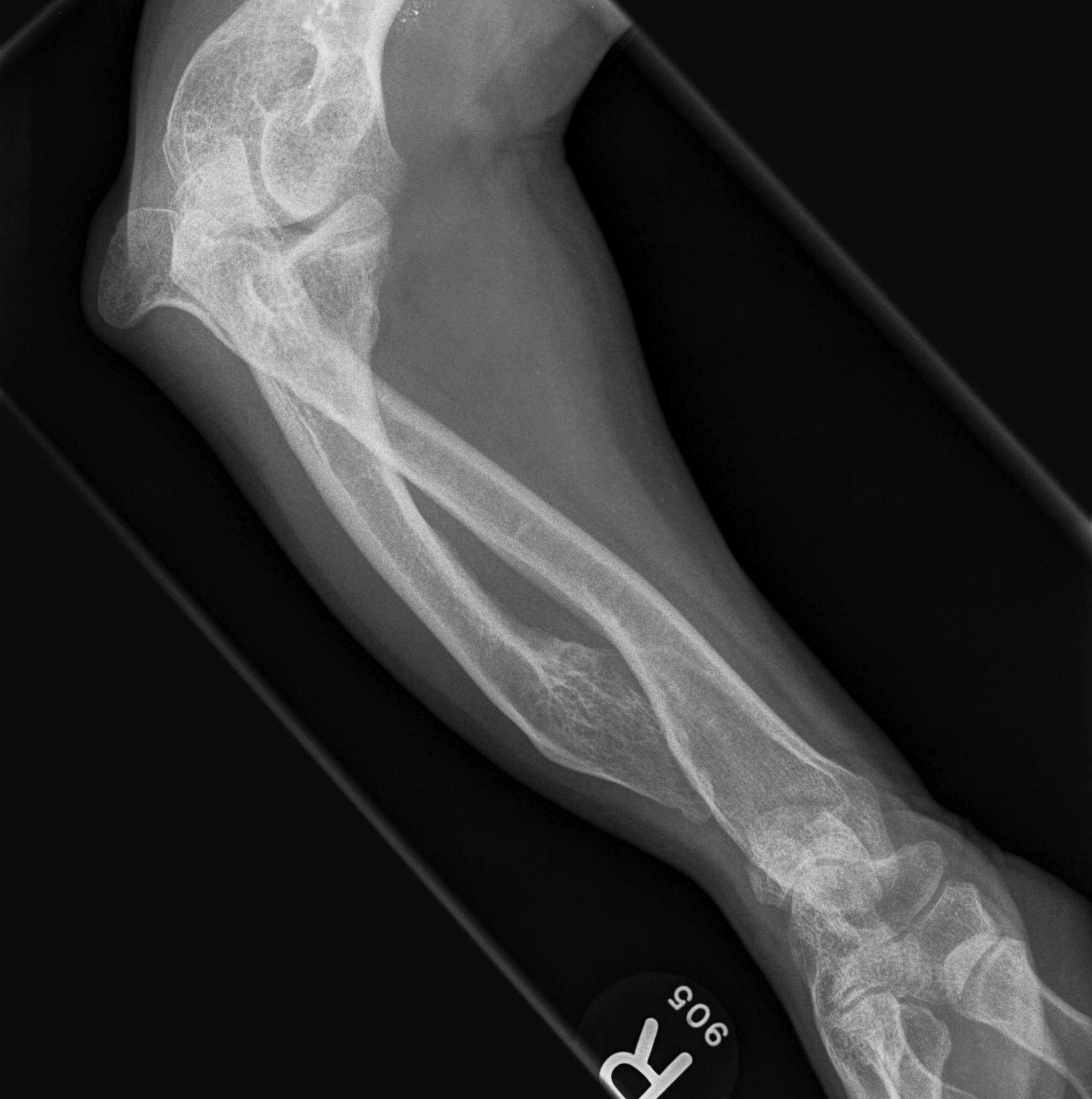 Osteochondromas Forearm 1